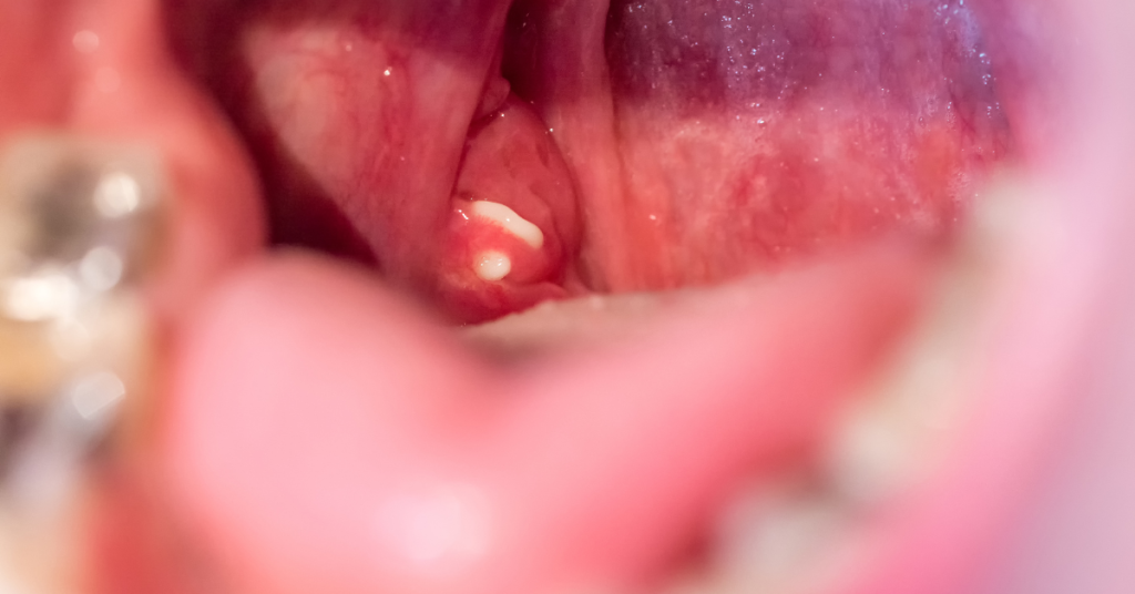 Tonsils Regrowth Mechanism