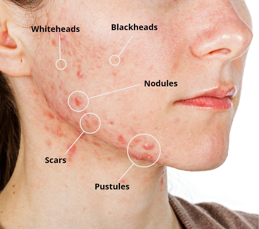 acne treatment Orange CA