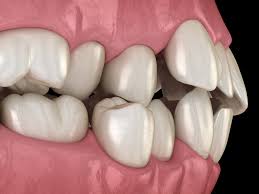 protruding teeth