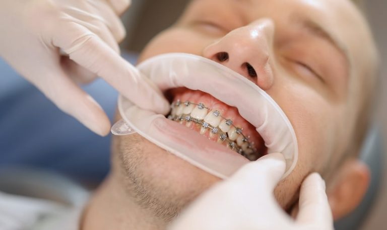 Why Choose an Orthodontist for Your Smile Transformation?