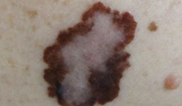 melanoma treatment Irvine CA